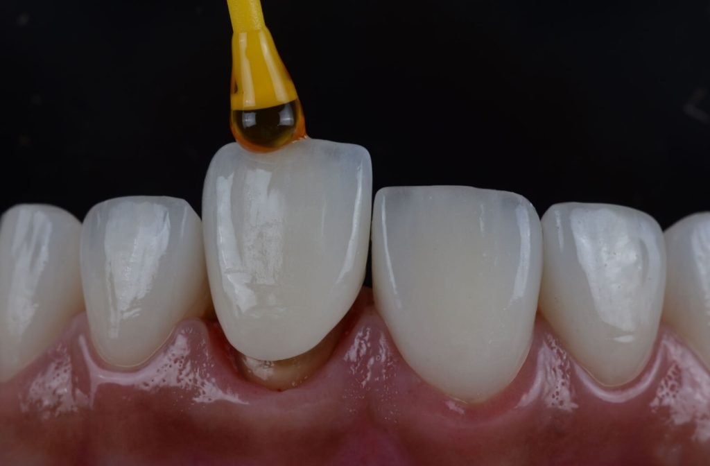 CEREC CROWNS AREN'T FITTING