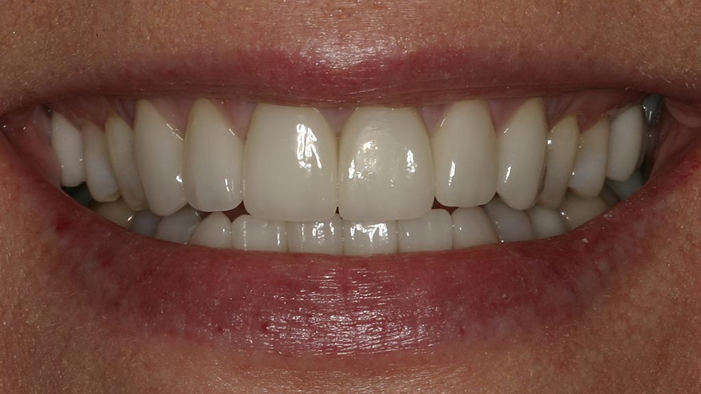 ROOPER DENTAL CEREC CROWNS FOR FRONT TEETH