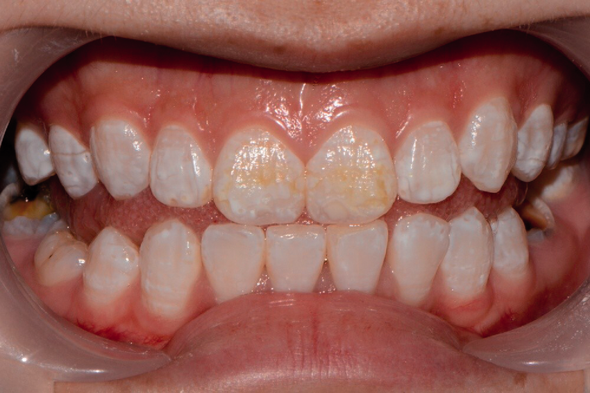 Fluorosis