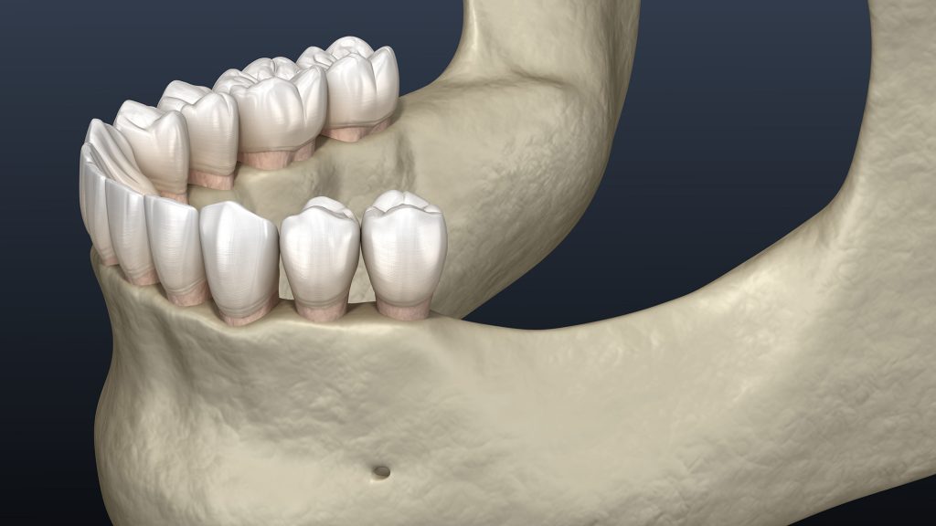 Enhance Your Bone Structure with Ridge Augmentation in Mesa