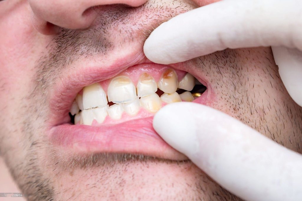 How to Combat Tooth Decay in Mesa