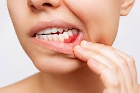 Treatment of Gum Disease and Gingivitis