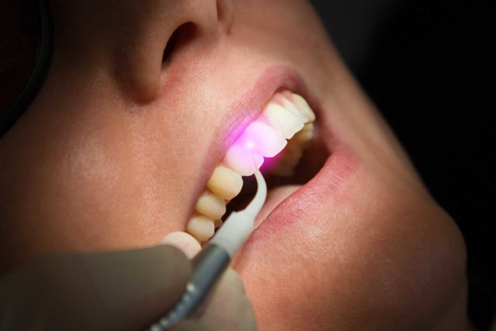 Laser Dentistry For Cavities Laser Dentistry For Cavities