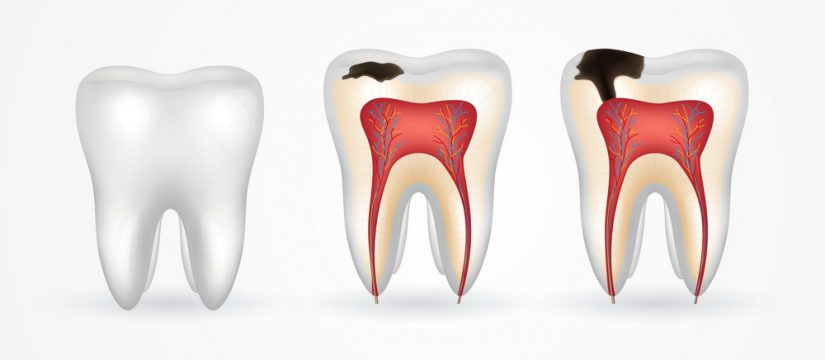 How Enamel Dentistry Help Prevent Tooth Decay and Sensitivity?