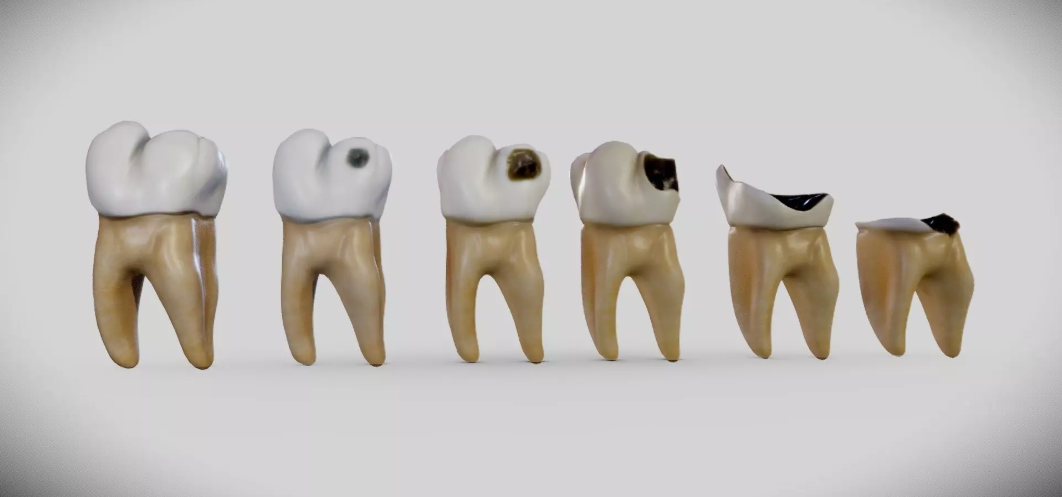 tooth decay