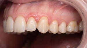 Early gum inflammation around natural teeth illustrating what causes gum disease