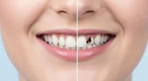 Dental illustration showing effects of a missing tooth including shifting teeth and jaw imbalance in Mesa, AZ