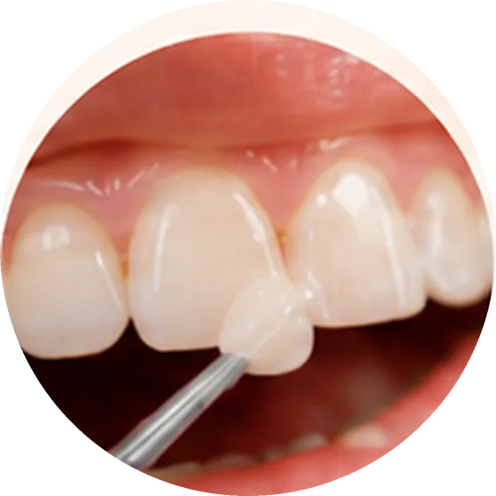 Composite Resin