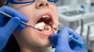 What are dental sealants? A dentist applies a protective coating to a child's molar