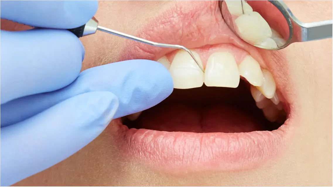 Gum Grafting Surgery
